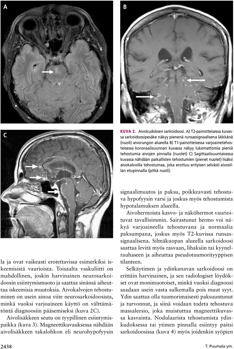 lukemattomia pieniä tehostumia aivojen pinnalla (nuolet) C) Sagittaalisuuntaisessa kuvassa nähdään paikallisten tehostumien (pienet nuolet) lisäksi aivokalvoilla tehostumaa, joka erottuu erityisen