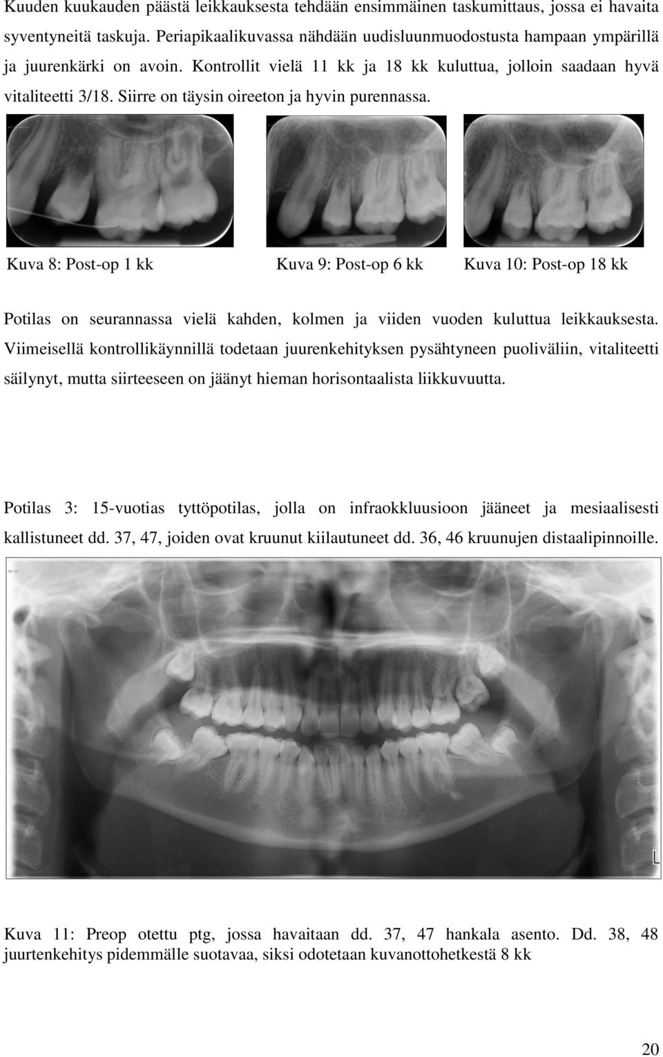 Siirre on täysin oireeton ja hyvin purennassa. Kuva 8: Post-op 1 kk Kuva 9: Post-op 6 kk Kuva 10: Post-op 18 kk Potilas on seurannassa vielä kahden, kolmen ja viiden vuoden kuluttua leikkauksesta.