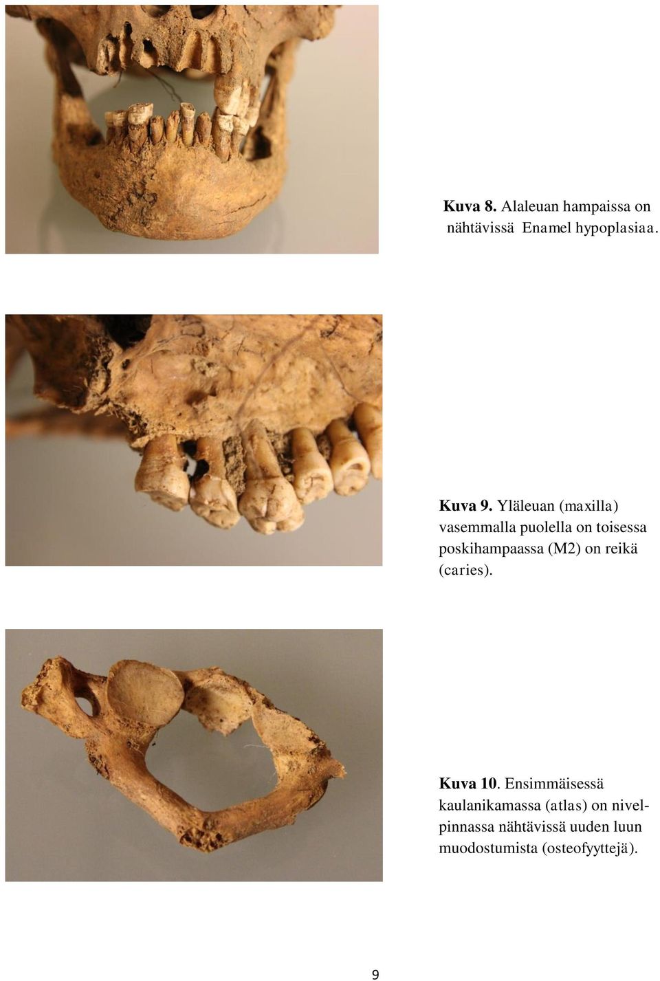 (M2) on reikä (caries). Kuva 10.