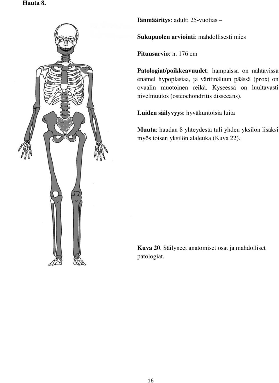 muotoinen reikä. Kyseessä on luultavasti nivelmuutos (osteochondritis dissecans).