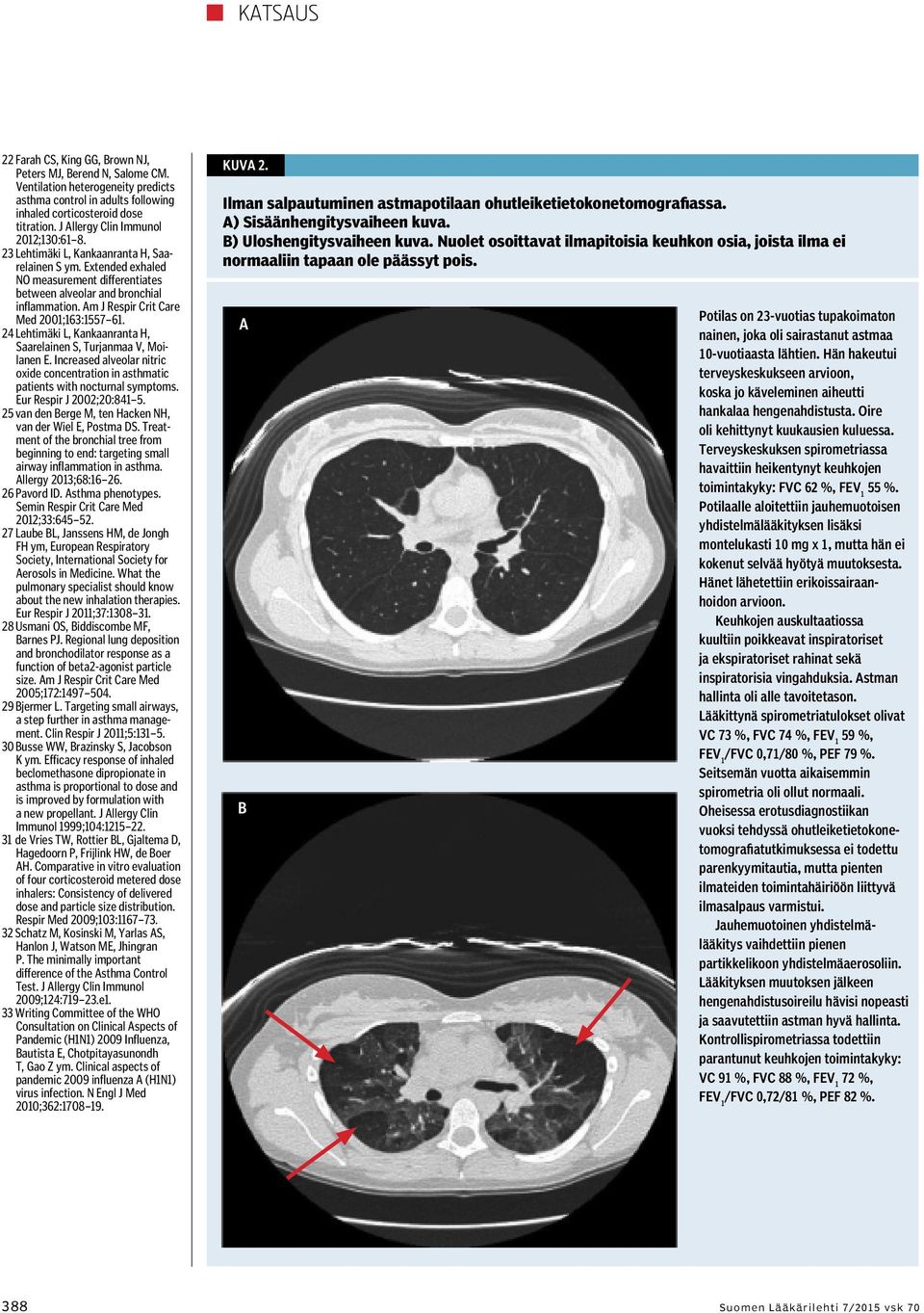 Am J Respir Crit Care Med 2001;163:1557 61. 24 Lehtimäki L, Kankaanranta H, Saarelainen S, Turjanmaa V, Moilanen E.