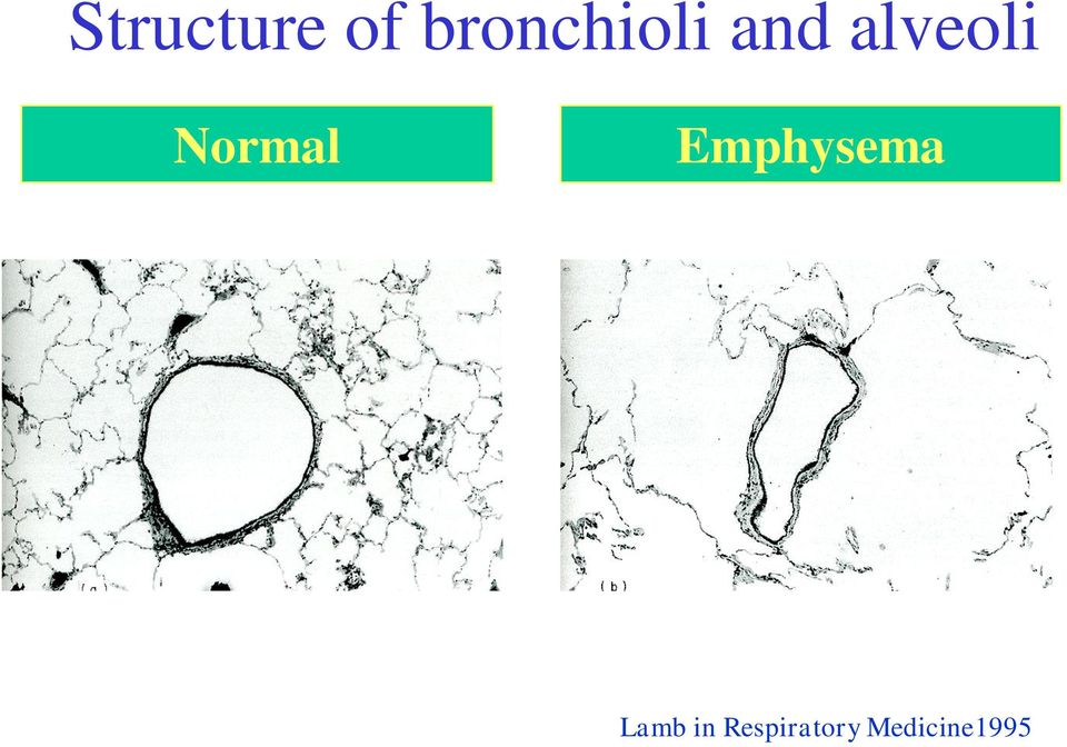 alveoli Normal