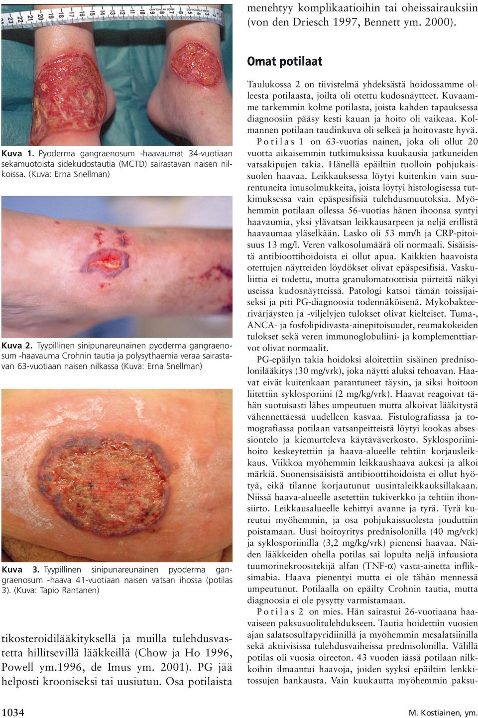 Tyypillinen sinipunareunainen pyoderma gangraenosum -haavauma Crohnin tautia ja polysythaemia veraa sairastavan 63-vuotiaan naisen nilkassa (Kuva: Erna Snellman) Kuva 3.