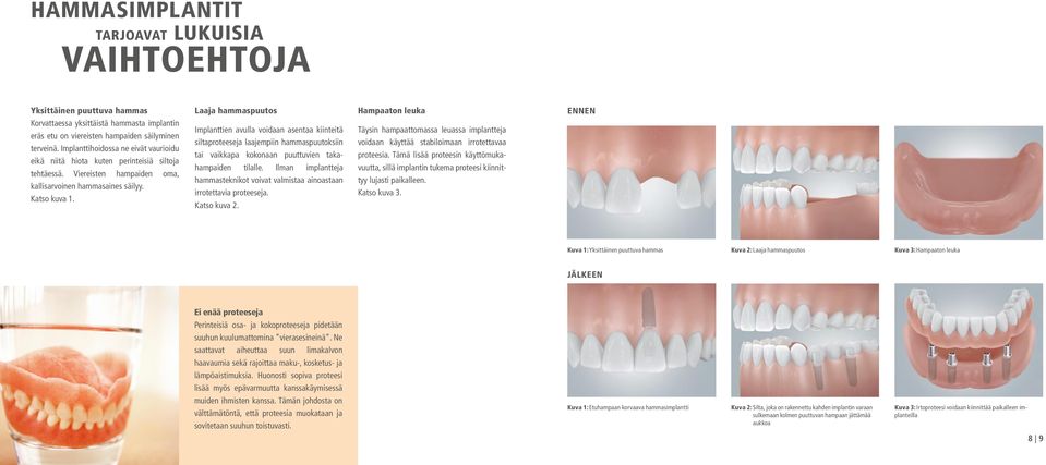 Implanttien avulla voidaan asentaa kiinteitä siltaproteeseja laajempiin hammaspuutoksiin tai vaikkapa kokonaan puuttuvien takahampaiden tilalle.