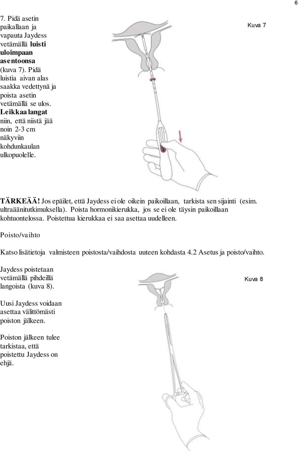 ultraäänitutkimuksella). Poista hormonikierukka, jos se ei ole täysin paikoillaan kohtuontelossa. Poistettua kierukkaa ei saa asettaa uudelleen.