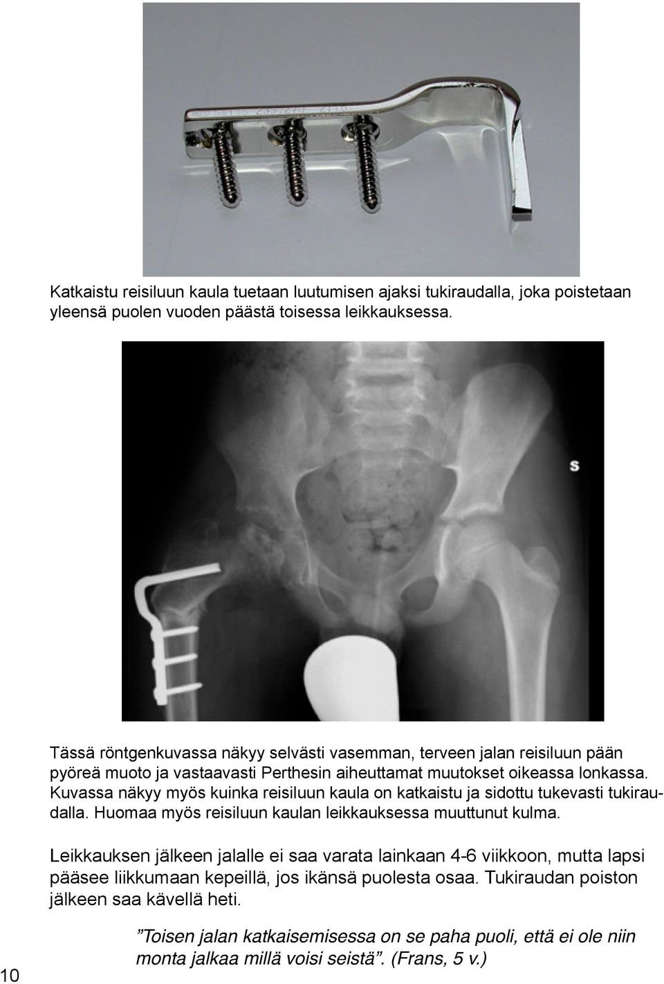 Kuvassa näkyy myös kuinka reisiluun kaula on katkaistu ja sidottu tukevasti tukiraudalla. Huomaa myös reisiluun kaulan leikkauksessa muuttunut kulma.