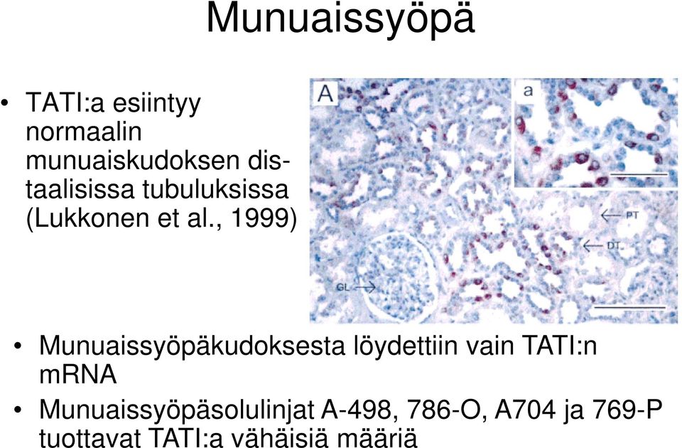 , 1999) Munuaissyöpäkudoksesta löydettiin vain TATI:n mrna