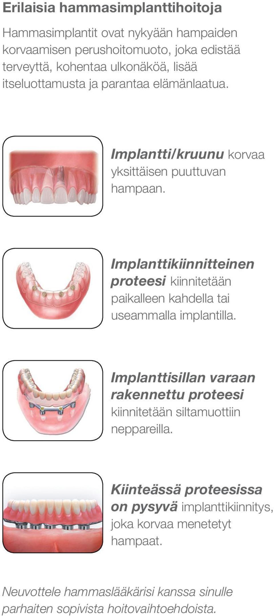 Implanttikiinnitteinen proteesi kiinnitetään paikalleen kahdella tai useammalla implantilla.