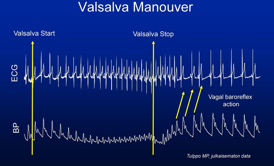 Stop Vagal baroreflex