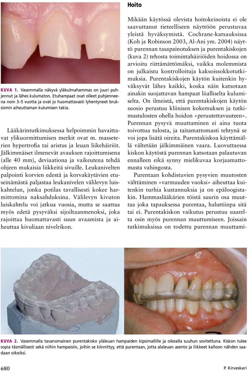 Lääkärintutkimuksessa helpoimmin havaittavat ylikuormittumisen merkit ovat m. masseterien hypertrofia tai aristus ja leuan liikehäiriöt.