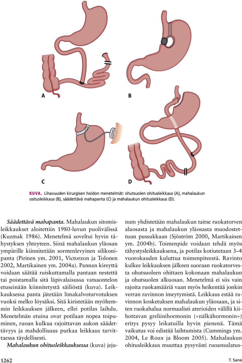 Siinä mahalaukun yläosan ympärille kiinnitetään sormenlevyinen silikonipanta (Pirinen ym. 2001, Victorzon ja Tolonen 2002, Martikainen ym. 2004a).