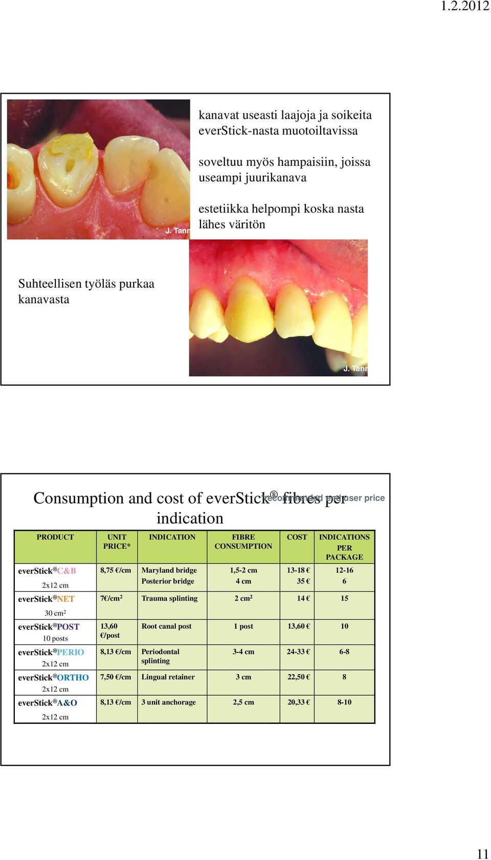 Tanner Consumption and cost of everstick fibres per indication PRODUCT UNIT PRICE* INDICATION FIBRE CONSUMPTION COST INDICATIONS PER PACKAGE everstick C&B 8,75 /cm Maryland bridge Posterior