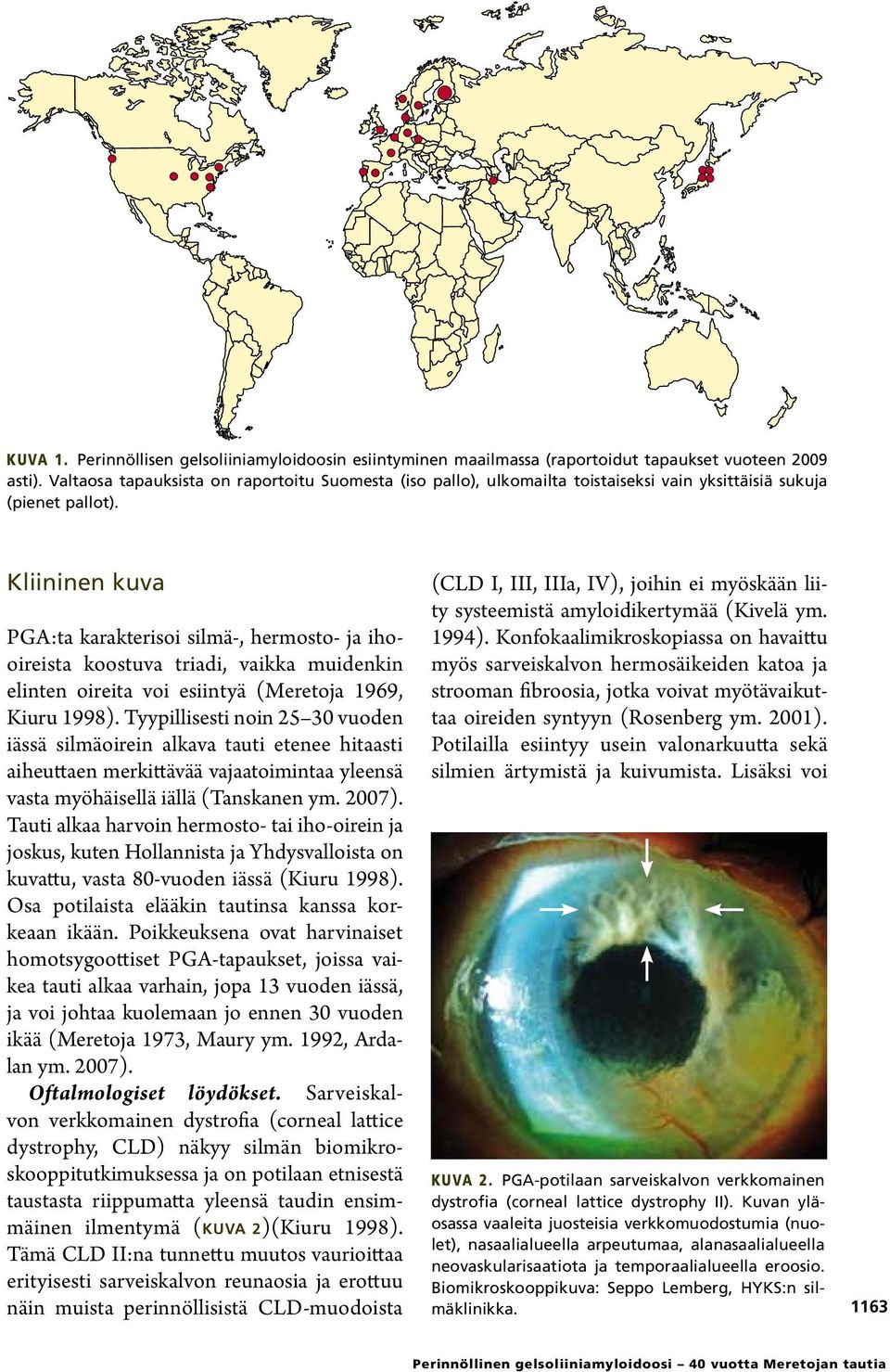 Kliininen kuva PGA:ta karakterisoi silmä-, hermosto- ja ihooireista koostuva triadi, vaikka muidenkin elinten oireita voi esiintyä (Meretoja 1969, Kiuru 1998).