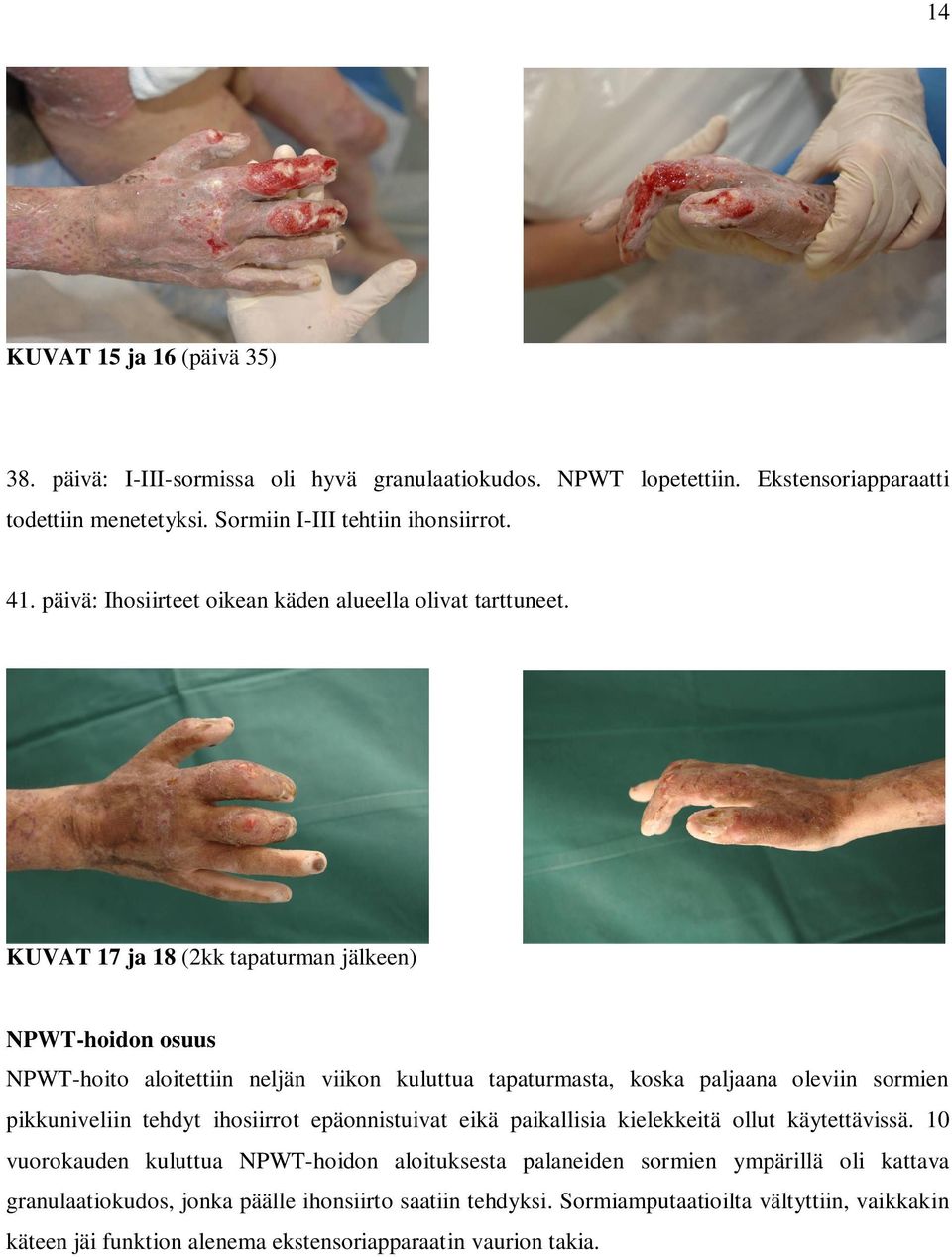 KUVAT 17 ja 18 (2kk tapaturman jälkeen) NPWT-hoidon osuus NPWT-hoito aloitettiin neljän viikon kuluttua tapaturmasta, koska paljaana oleviin sormien pikkuniveliin tehdyt ihosiirrot