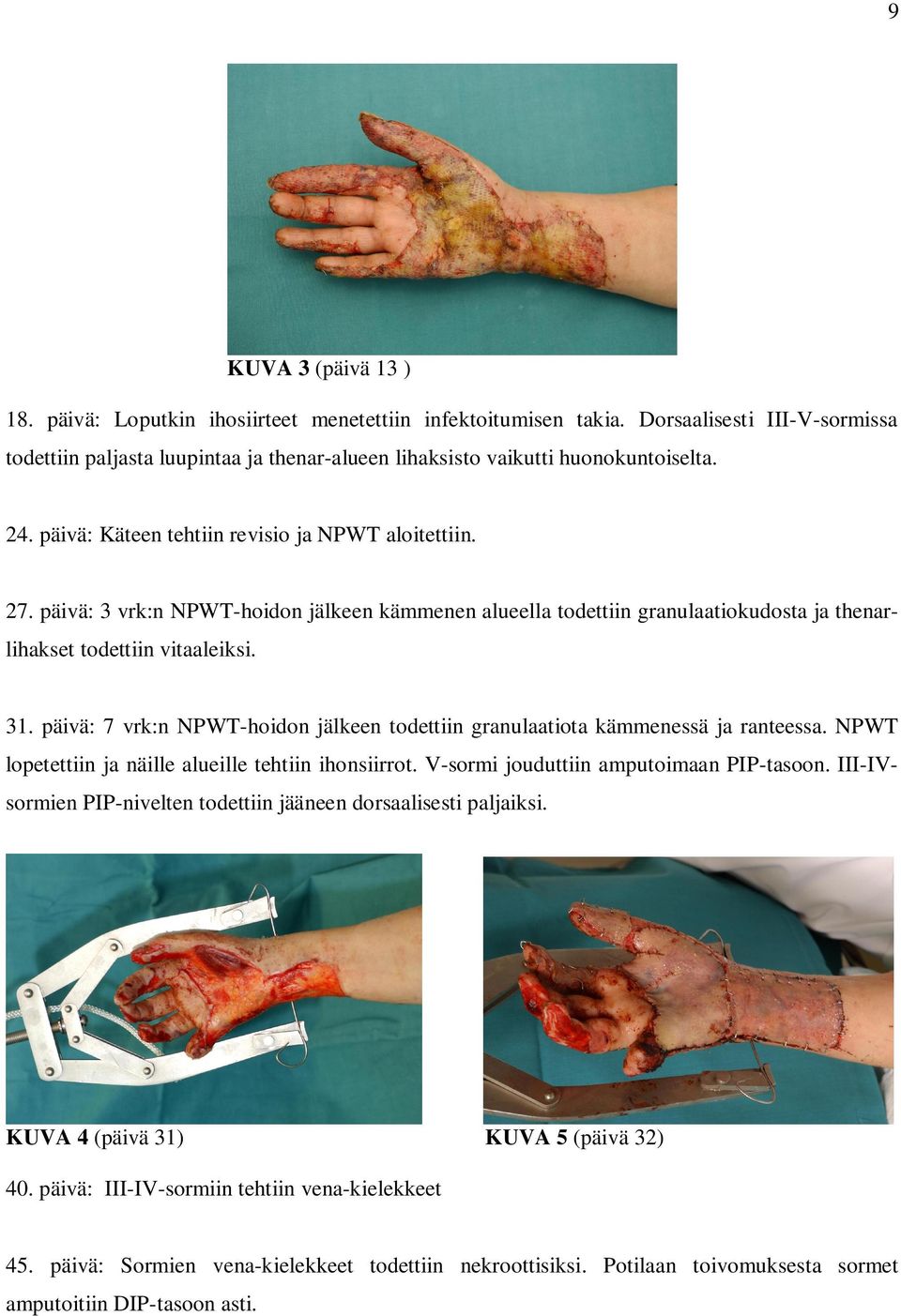 päivä: 7 vrk:n NPWT-hoidon jälkeen todettiin granulaatiota kämmenessä ja ranteessa. NPWT lopetettiin ja näille alueille tehtiin ihonsiirrot. V-sormi jouduttiin amputoimaan PIP-tasoon.
