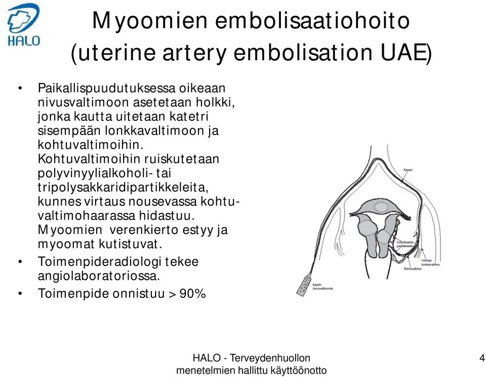 Kohtuvaltimoihin ruiskutetaan polyvinyylialkoholi- tai tripolysakkaridipartikkeleita, kunnes virtaus nousevassa