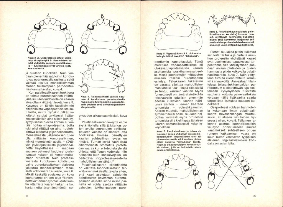 kova keskialue. Kuva 3. A. Osaproteesin satulat ytidlstetty akryyiiievyiiä B. Samanlaiset satulat yhdistetty kapealla metalllkaarella ^ tuklhampaat eivät tarvitse lisätukea suulaesta.
