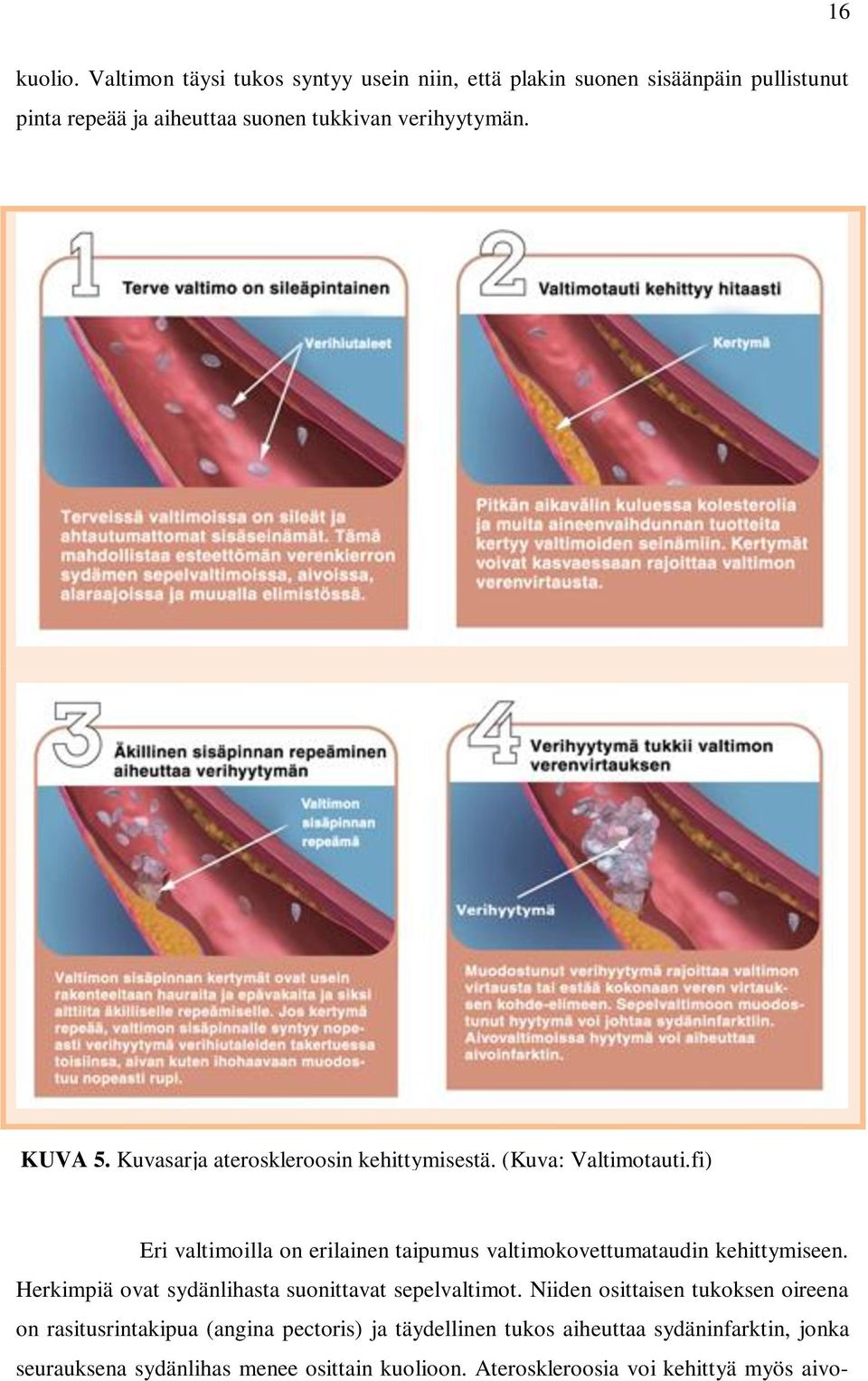 KUVA 5. Kuvasarja ateroskleroosin kehittymisestä. (Kuva: Valtimotauti.