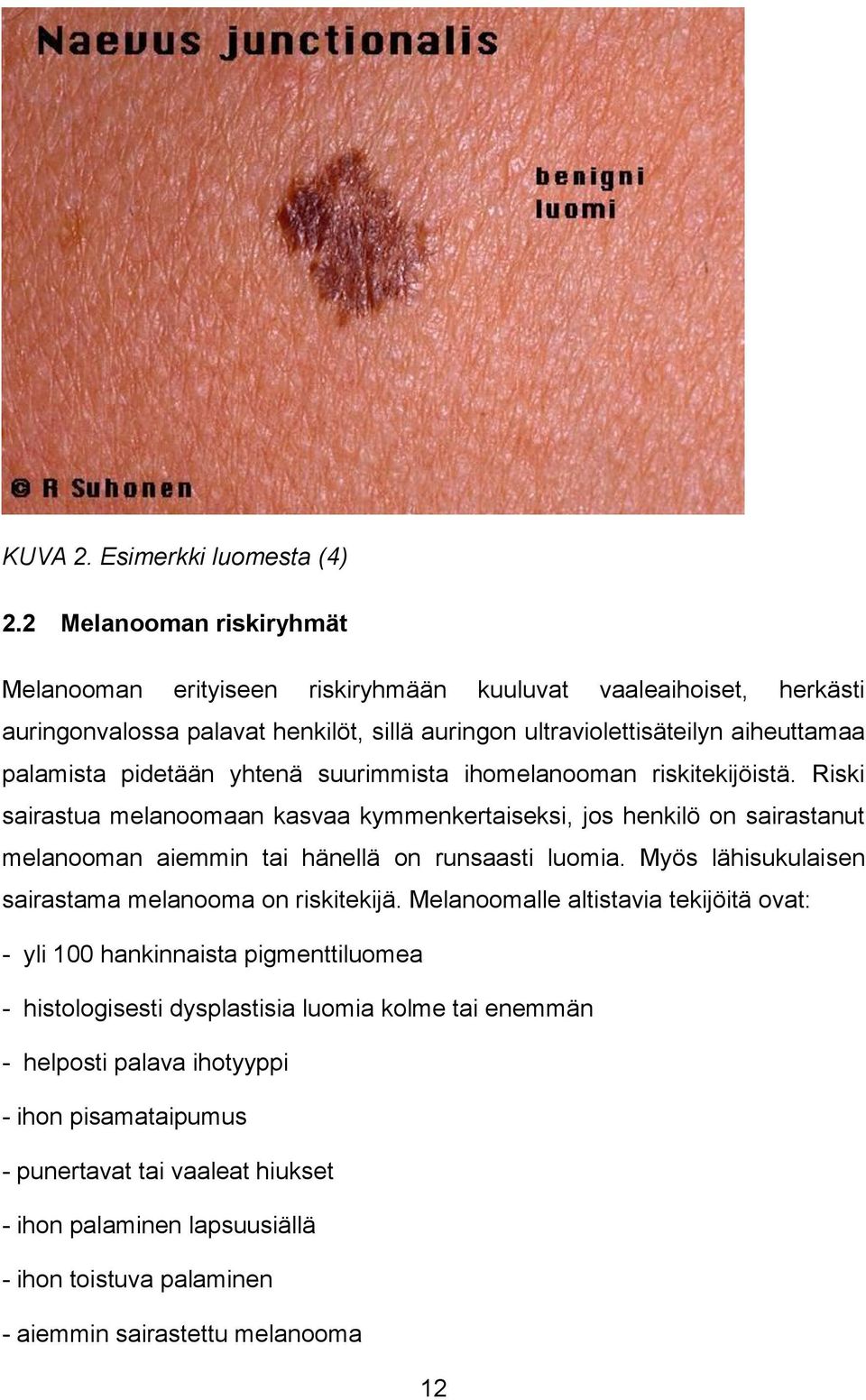 pidetään yhtenä suurimmista ihomelanooman riskitekijöistä. Riski sairastua melanoomaan kasvaa kymmenkertaiseksi, jos henkilö on sairastanut melanooman aiemmin tai hänellä on runsaasti luomia.