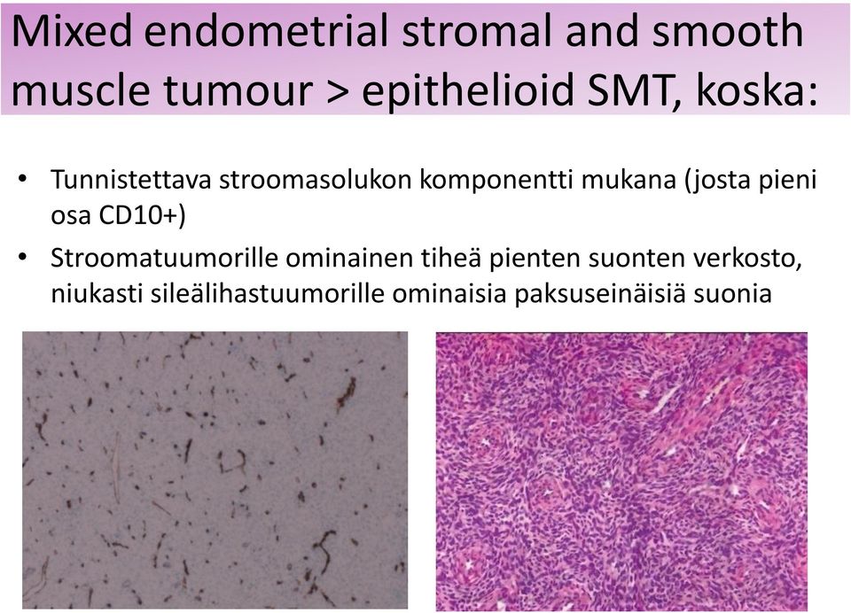 pieni osa CD10+) Stroomatuumorille ominainen tiheä pienten suonten