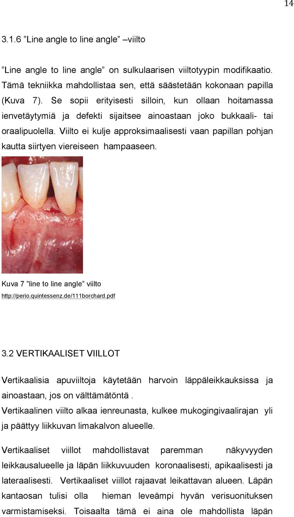 Viilto ei kulje approksimaalisesti vaan papillan pohjan kautta siirtyen viereiseen hampaaseen. Kuva 7 line to line angle viilto http://perio.quintessenz.de/111borchard.pdf 3.
