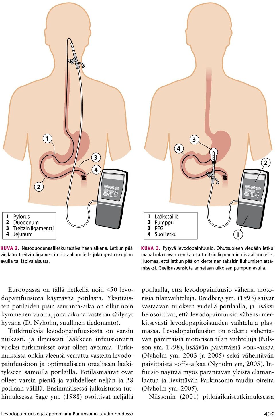 Ohutsuoleen viedään letku mahalaukkuavanteen kautta Treitzin ligamentin distaalipuolelle. Huomaa, että letkun pää on kierteinen takaisin liukumisen estämiseksi.