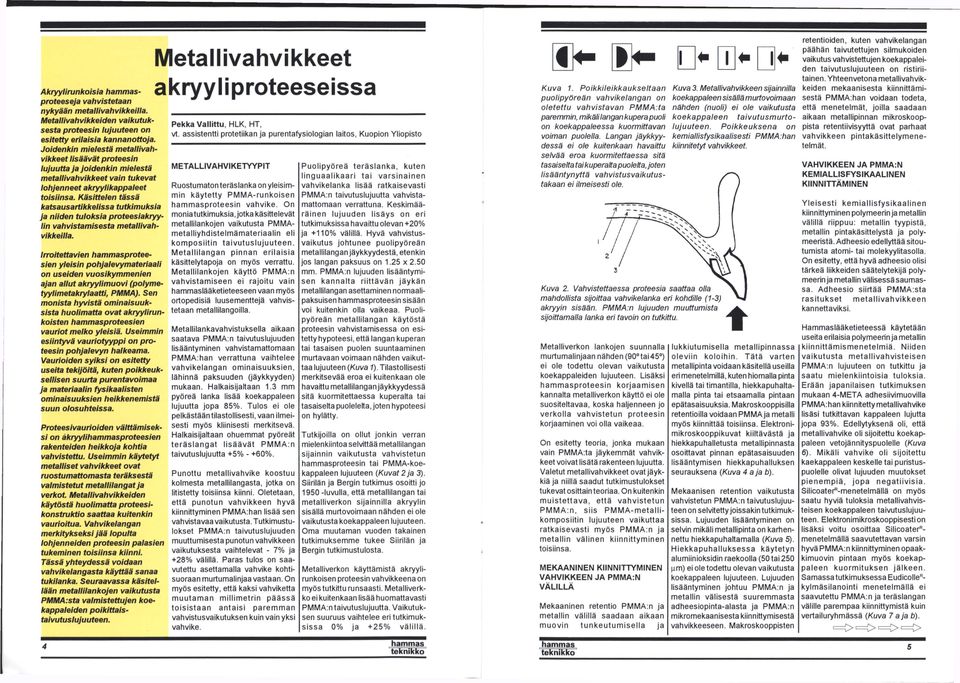 Käsittelen tässä katsausartikkelissa tutkimuksia ja niiden tuloksia proteesiakryylin vahvistamisesta metallivahvikkeilla.