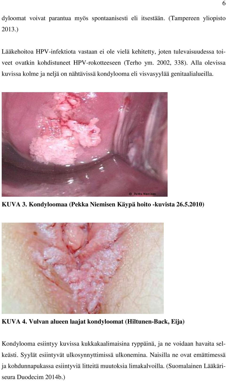 Alla olevissa kuvissa kolme ja neljä on nähtävissä kondylooma eli visvasyylää genitaalialueilla. KUVA 3. Kondyloomaa (Pekka Niemisen Käypä hoito -kuvista 26.5.2010) KUVA 4.