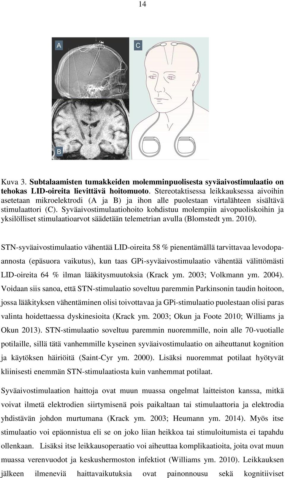 Syväaivostimulaatiohoito kohdistuu molempiin aivopuoliskoihin ja yksilölliset stimulaatioarvot säädetään telemetrian avulla (Blomstedt ym. 2010).