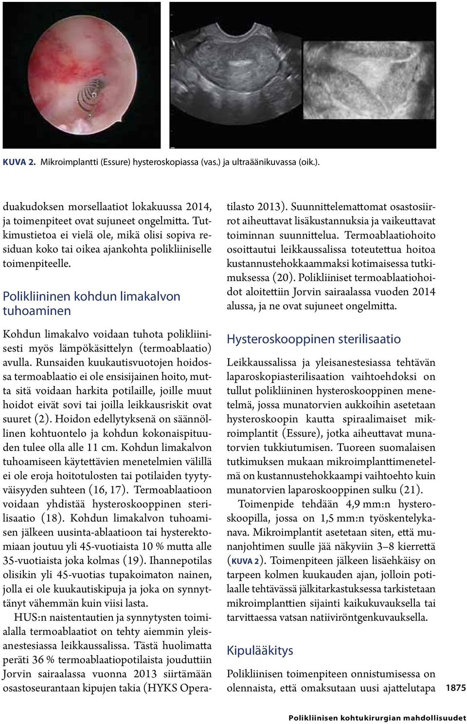 Polikliininen kohdun limakalvon tuhoaminen Kohdun limakalvo voidaan tuhota polikliinisesti myös lämpökäsittelyn (termoablaatio) avulla.