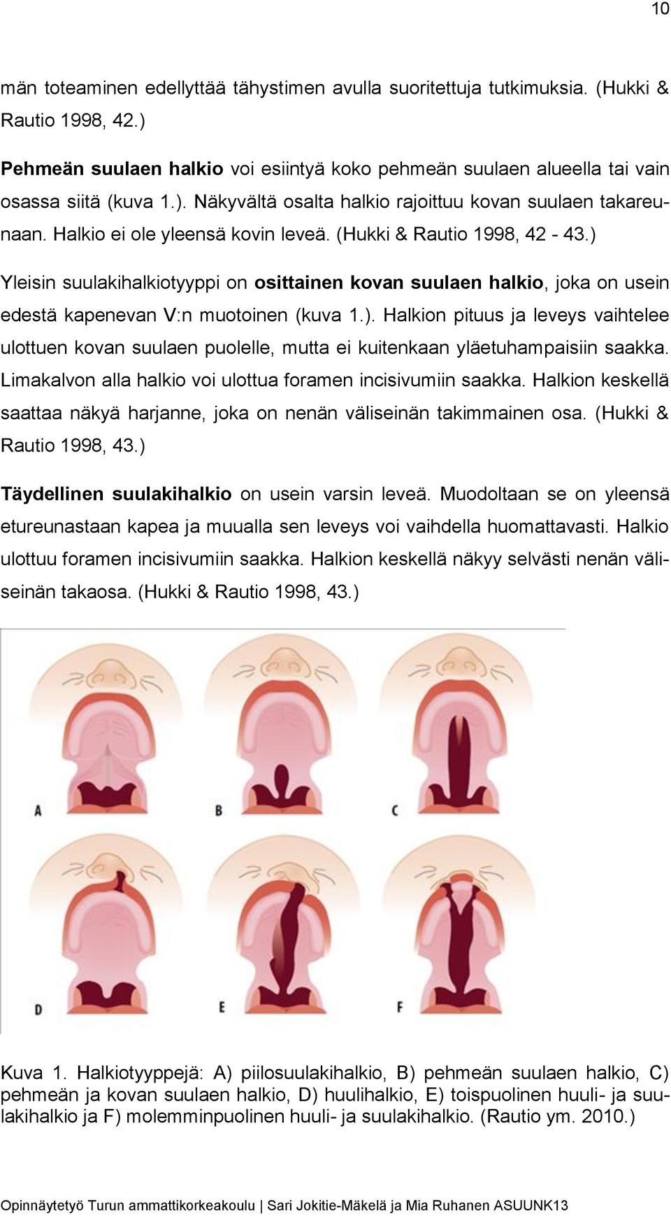 Limakalvon alla halkio voi ulottua foramen incisivumiin saakka. Halkion keskellä saattaa näkyä harjanne, joka on nenän väliseinän takimmainen osa. (Hukki & Rautio 1998, 43.