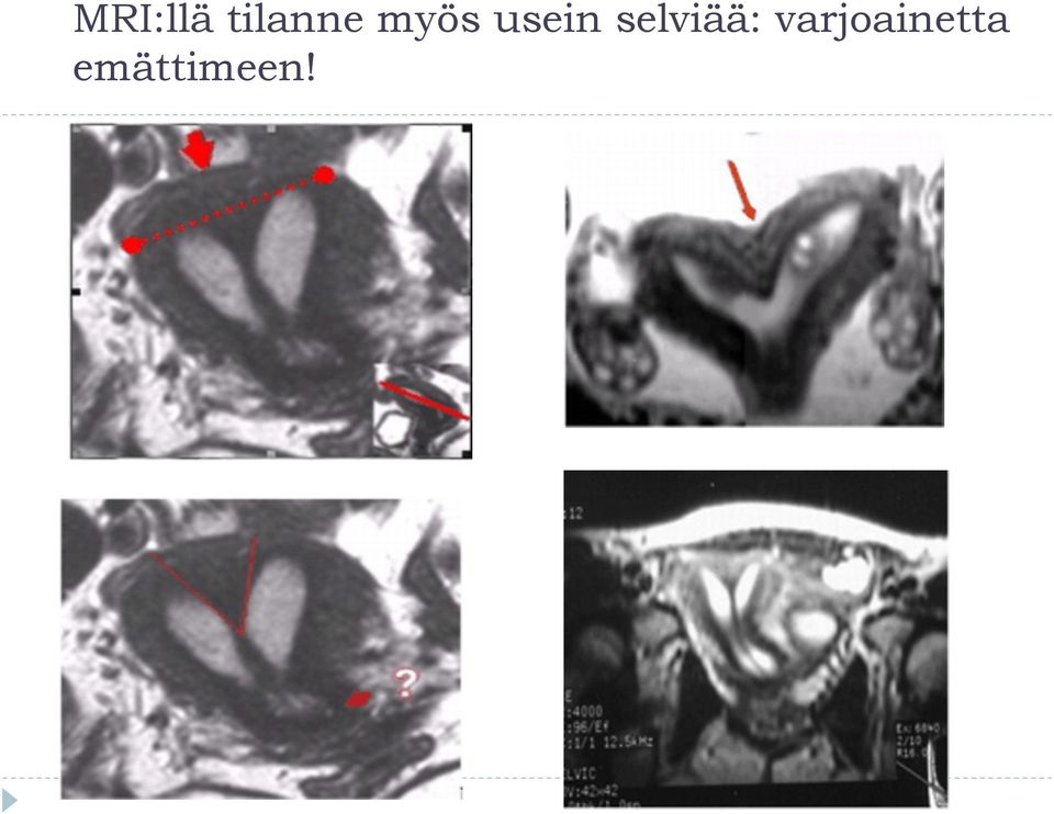 usein selviää: