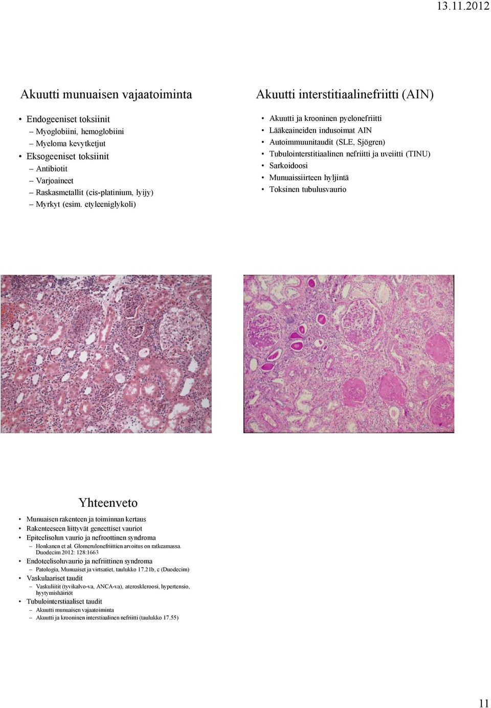 (TINU) Sarkoidoosi Munuaissiirteen hyljintä Toksinen tubulusvaurio Yhteenveto Munuaisen rakenteen ja toiminnan kertaus Rakenteeseen liittyvät geneettiset vauriot Epiteelisolun vaurio ja nefroottinen