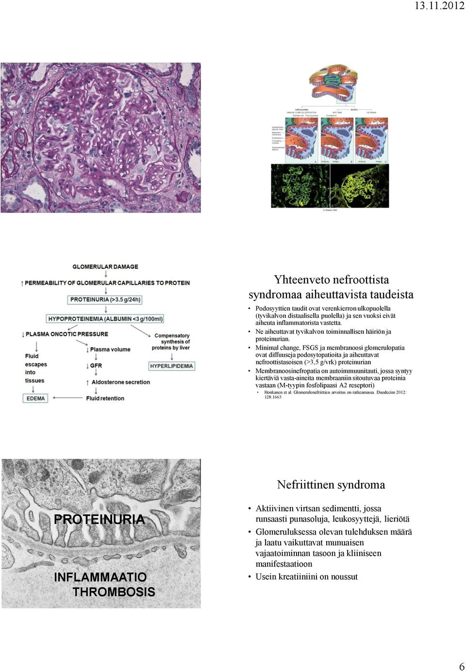 Minimal change, FSGS ja membranoosi glomerulopatia ovat diffuuseja podosytopatioita ja aiheuttavat nefroottistasoisen (>3,5 g/vrk) proteinurian Membranoosinefropatia on autoimmuunitauti, jossa syntyy