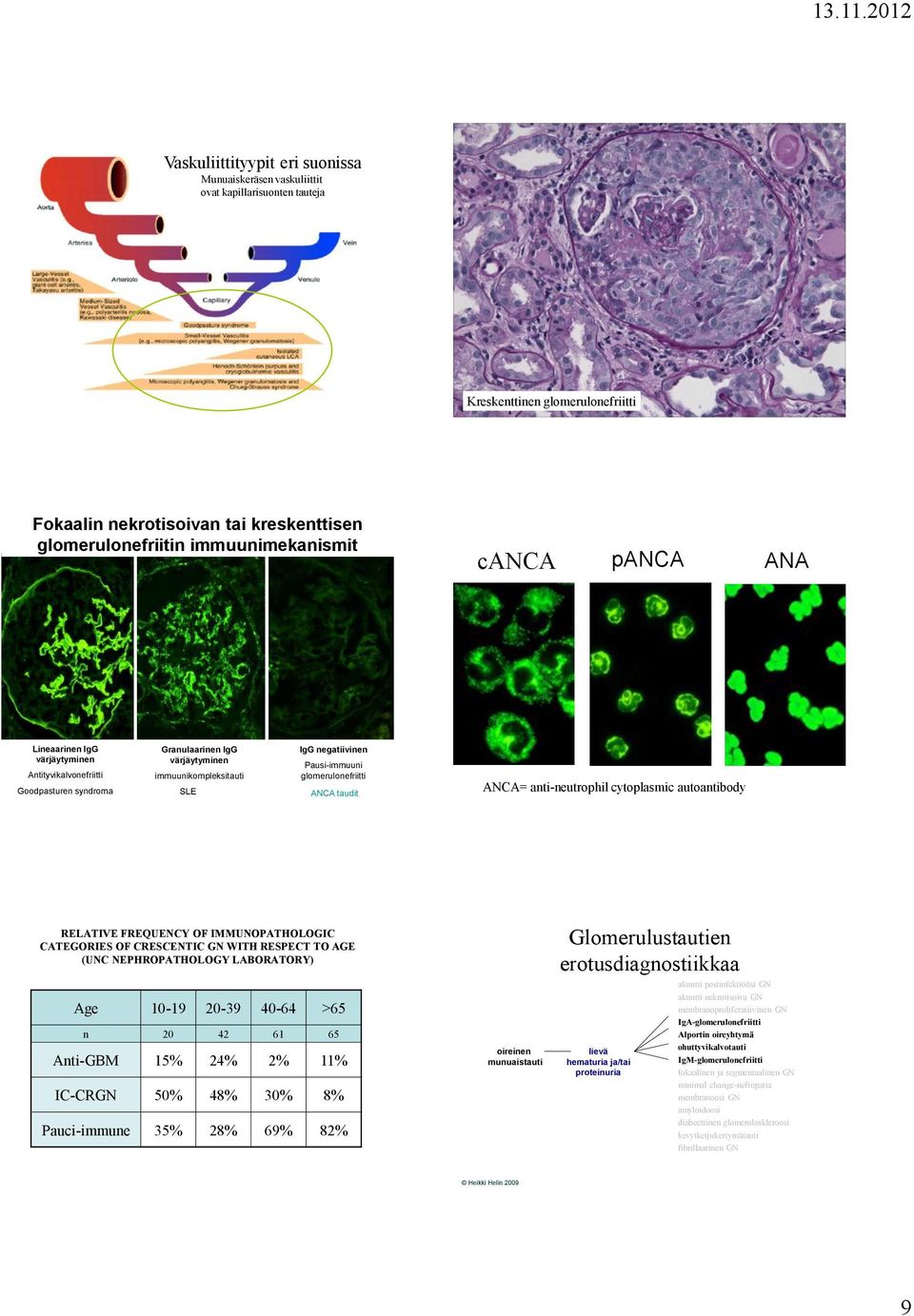 ANCA taudit ANCA= anti-neutrophil cytoplasmic autoantibody RELATIVE FREQUENCY OF IMMUNOPATHOLOGIC CATEGORIES OF CRESCENTIC GN WITH RESPECT TO AGE (UNC NEPHROPATHOLOGY LABORATORY) Age 10-19 20-39