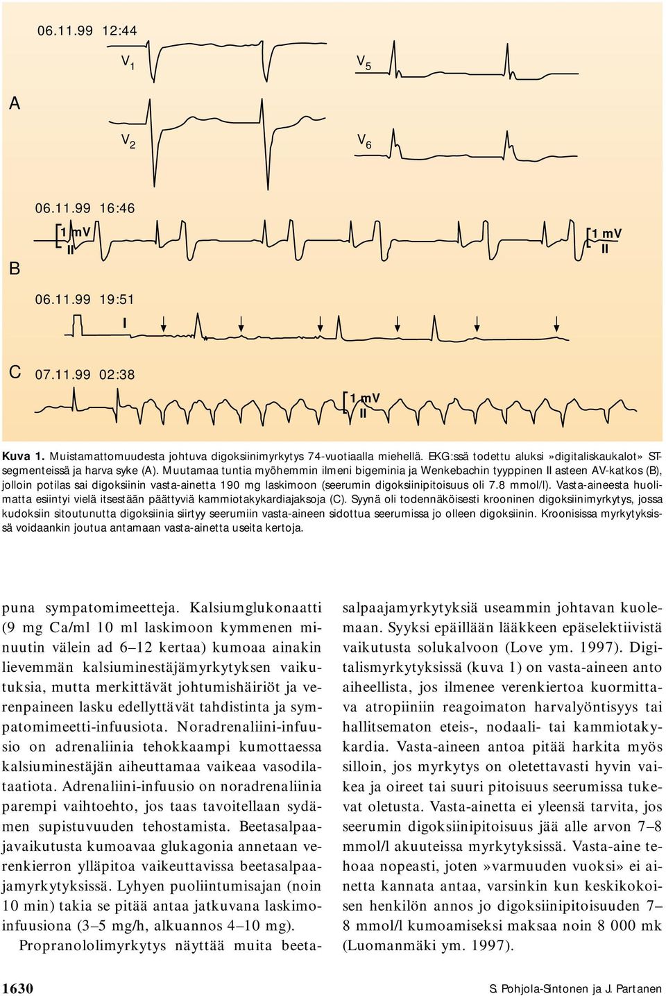 Muutamaa tuntia myöhemmin ilmeni bigeminia ja Wenkebachin tyyppinen asteen AV-katkos (B), jolloin potilas sai digoksiinin vasta-ainetta 190 mg laskimoon (seerumin digoksiinipitoisuus oli 7.8 mmol/l).