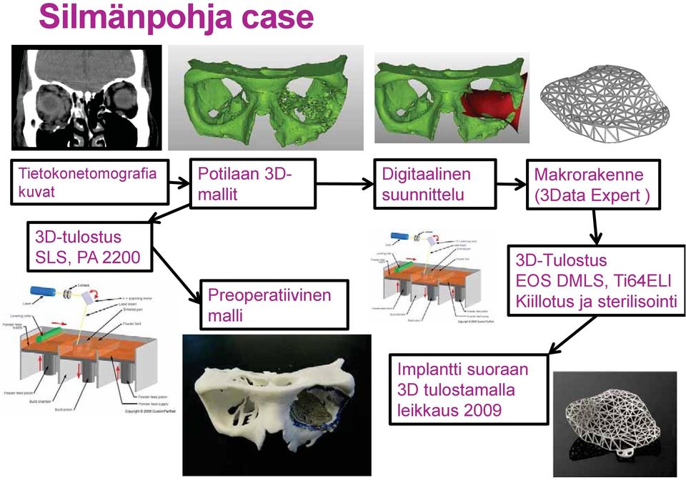 SLS, PA 2200 Preoperatiivinen malli 3D-Tulostus EOS DMLS, Ti64ELI