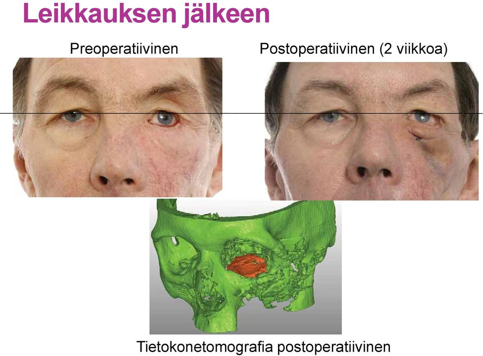 Postoperatiivinen (2