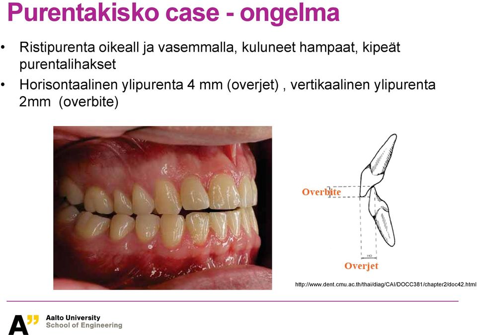 ylipurenta 4 mm (overjet), vertikaalinen ylipurenta 2mm