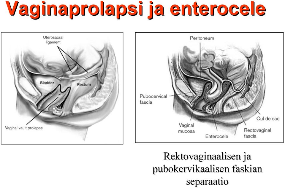 Rektovaginaalisen ja