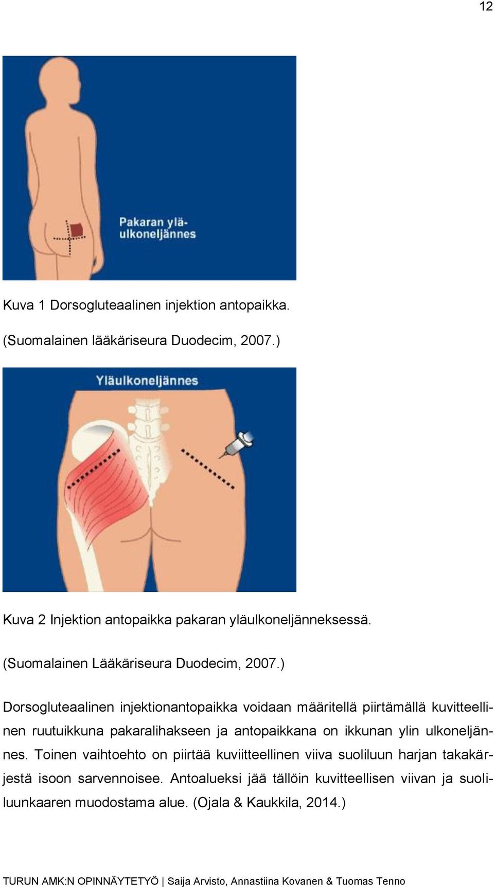 ) Dorsogluteaalinen injektionantopaikka voidaan määritellä piirtämällä kuvitteellinen ruutuikkuna pakaralihakseen ja antopaikkana on ikkunan