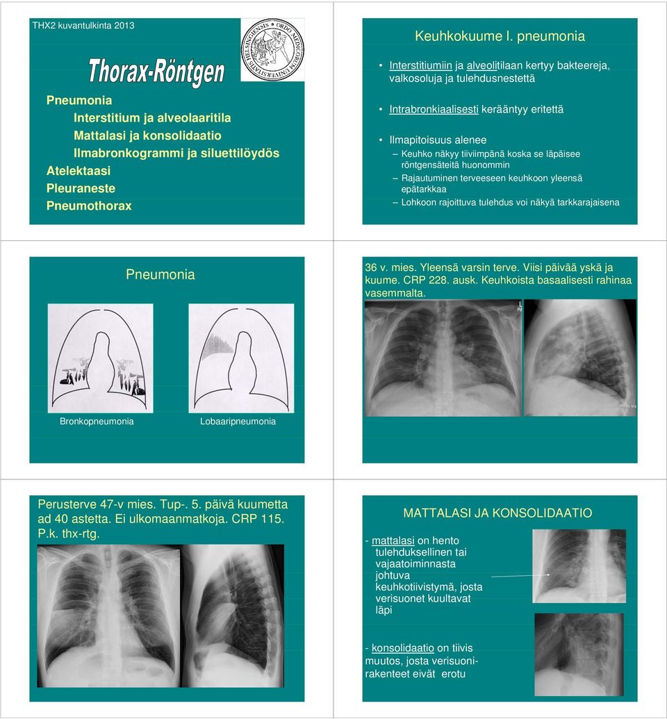 Atelektaasi Pleuraneste Pneumothorax Intrabronkiaalisesti kerääntyy eritettä Ilmapitoisuus alenee Keuhko näkyy tiiviimpänä koska se läpäisee röntgensäteitä huonommin Rajautuminen terveeseen keuhkoon