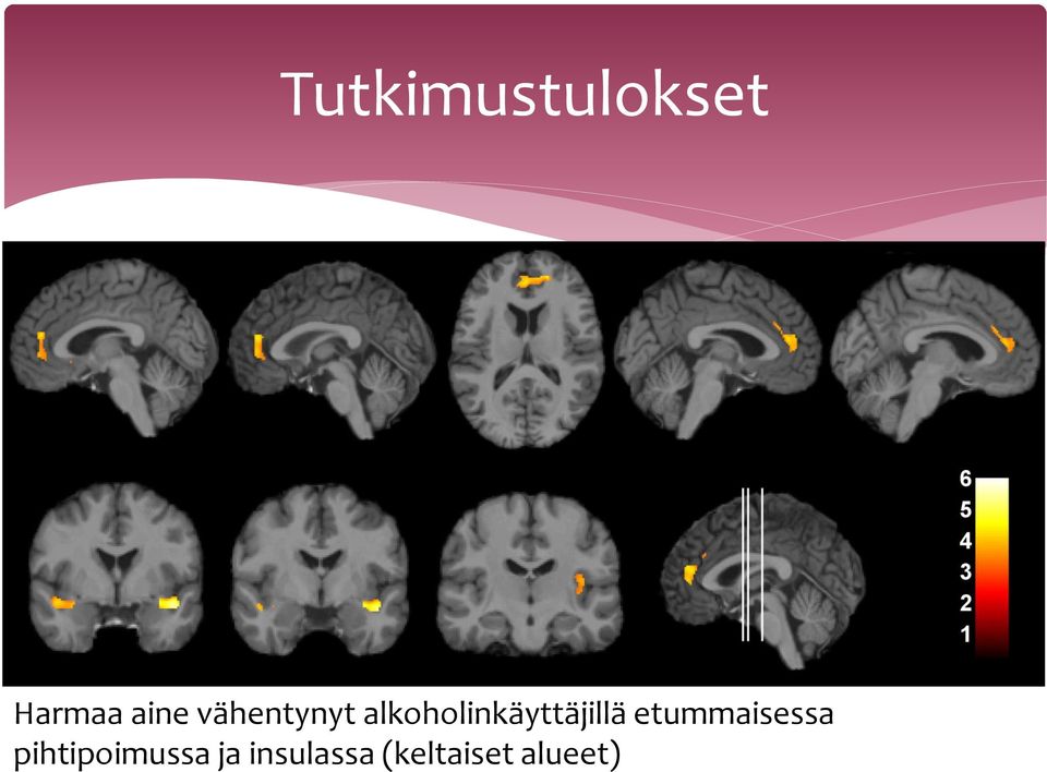 alkoholinkäyttäjillä