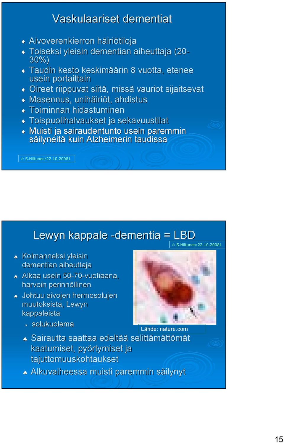 Alzheimerin taudissa Lewyn kappale -dementia = LBD Kolmanneksi yleisin dementian aiheuttaja Alkaa usein 50-70 70-vuotiaana, harvoin perinnöllinen Johtuu aivojen hermosolujen