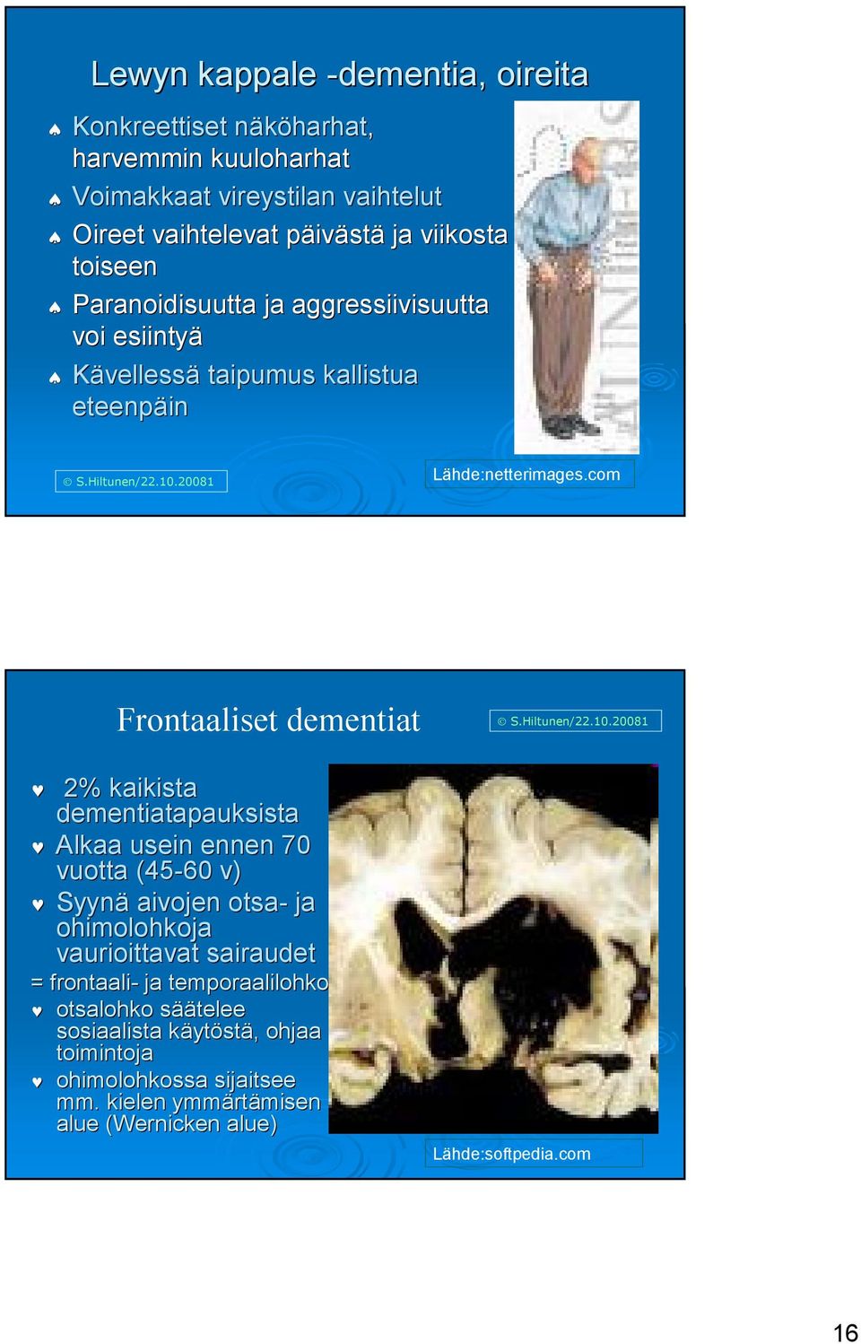 com Frontaaliset dementiat 2% kaikista dementiatapauksista Alkaa usein ennen 70 vuotta (45-60 v) Syynä aivojen otsa- ja ohimolohkoja vaurioittavat sairaudet =