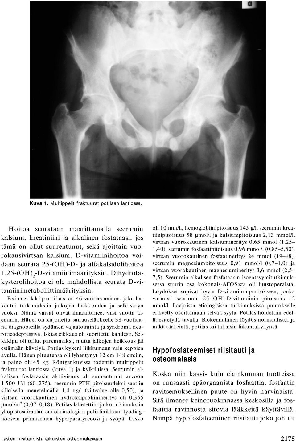 D-vitamiinihoitoa voidaan seurata 25-(OH)-D- ja alfakalsidolihoitoa 1,25-(OH) 2 -D-vitamiinimäärityksin. Dihydrotakysterolihoitoa ei ole mahdollista seurata D-vitamiinimetaboliittimäärityksin.