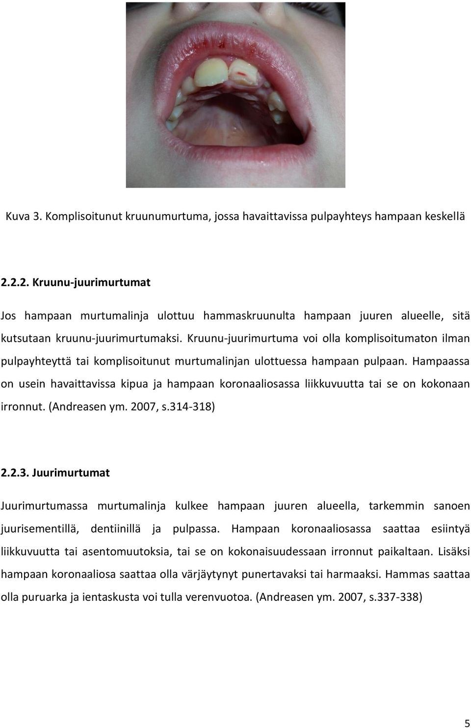 Kruunu-juurimurtuma voi olla komplisoitumaton ilman pulpayhteyttä tai komplisoitunut murtumalinjan ulottuessa hampaan pulpaan.