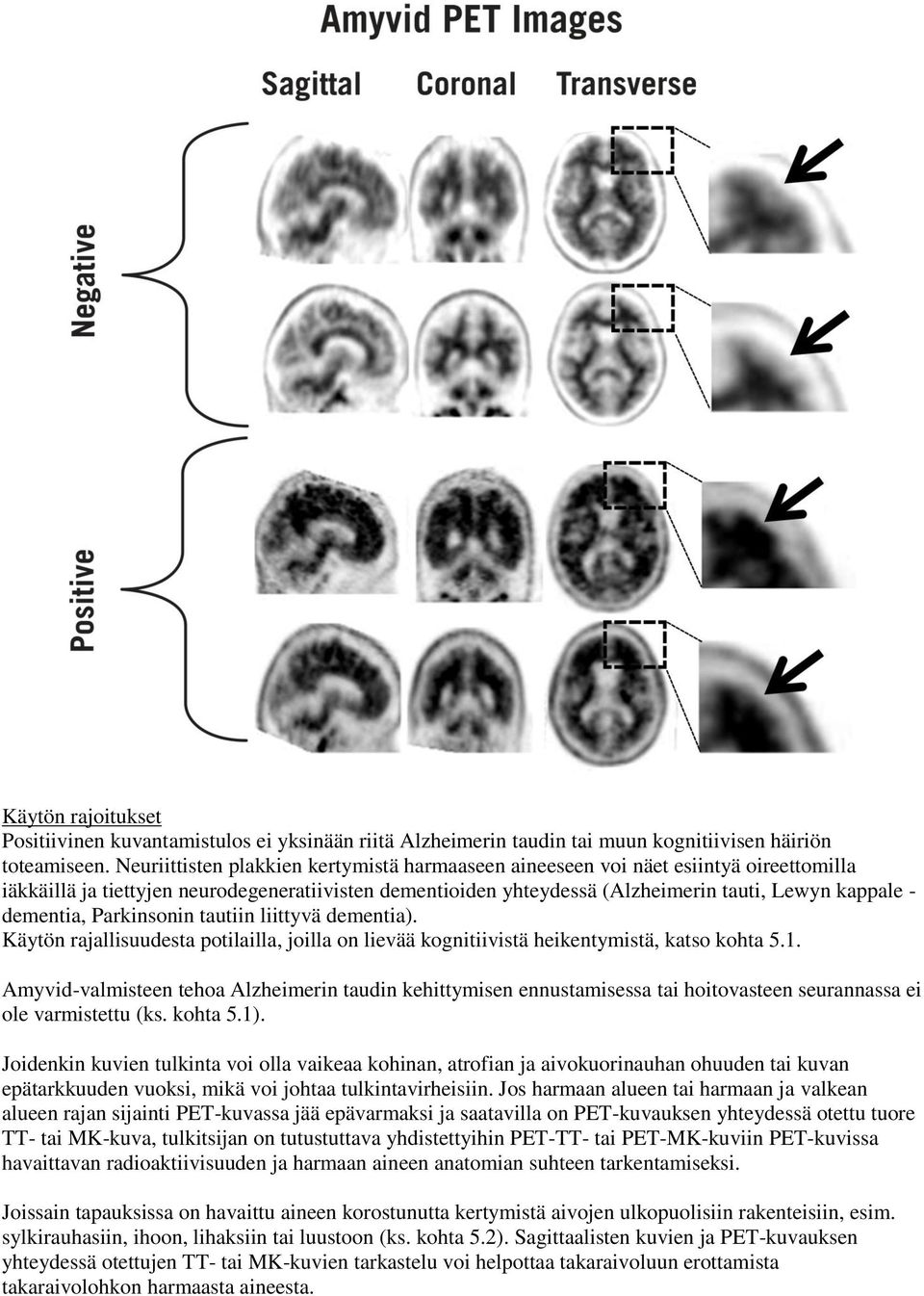 dementia, Parkinsonin tautiin liittyvä dementia). Käytön rajallisuudesta potilailla, joilla on lievää kognitiivistä heikentymistä, katso kohta 5.1.