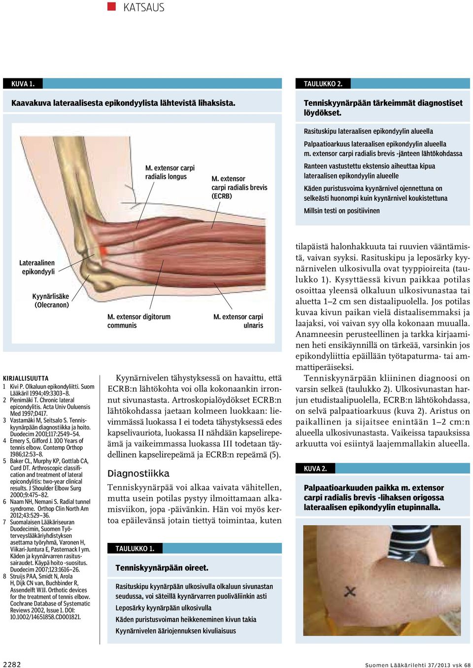 extensor carpi radialis brevis -jänteen lähtökohdassa Ranteen vastustettu ekstensio aiheuttaa kipua lateraalisen epikondyylin alueelle Käden puristusvoima kyynärnivel ojennettuna on selkeästi