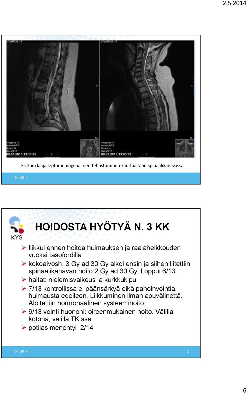 3 Gy ad 30 Gy alkoi ensin ja siihen liitettiin spinaalikanavan hoito 2 Gy ad 30 Gy. Loppui 6/13.